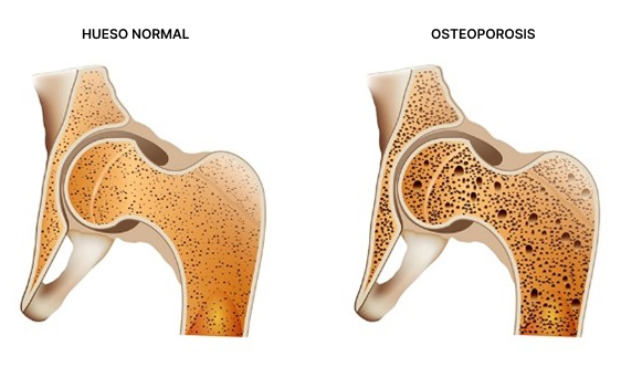 Osteoporosis